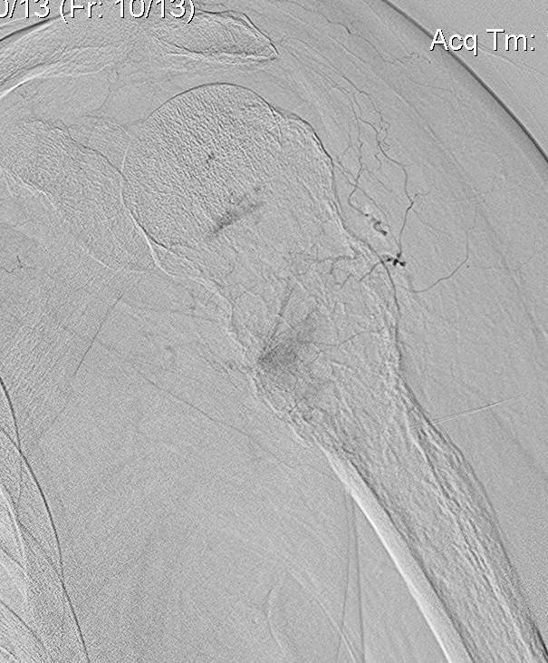 Shoulder RCC Embolisation 2